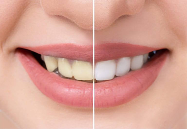 Meet Your Perfect West Chester Cosmetic Dentistry Match