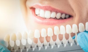 Dental Veneers Procedure and What to Expect